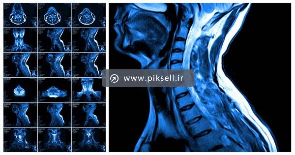 دانلود عکس با کیفیت از سی تی اسکن گردن و نمایش مهره ها